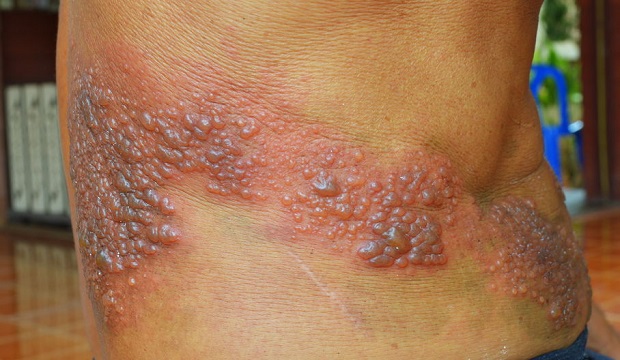 Thoracic Herpes Zoster