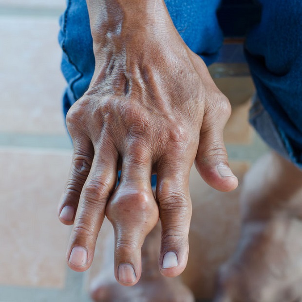 What Does Gout Look Like? Fingers