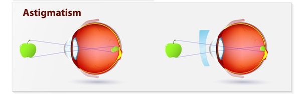 Astigmatism Correction