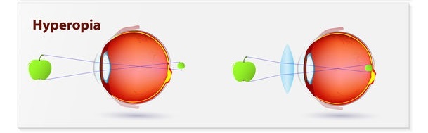 Hyperopia Correction