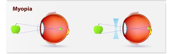 How Do Glasses Work to Correct Vision - Myopia Correction