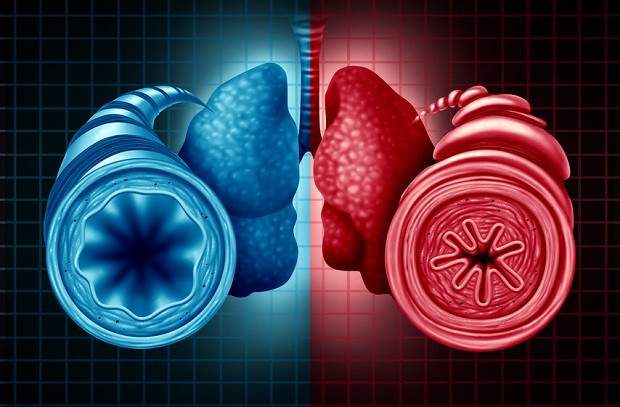 When Is Bronchitis Contagious - What Is It