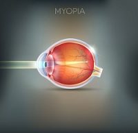 Myopia- Nearsightedness